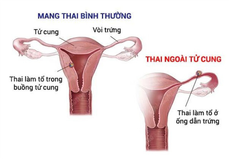 Chửa ngoài tử cung - Hình ảnh minh họa